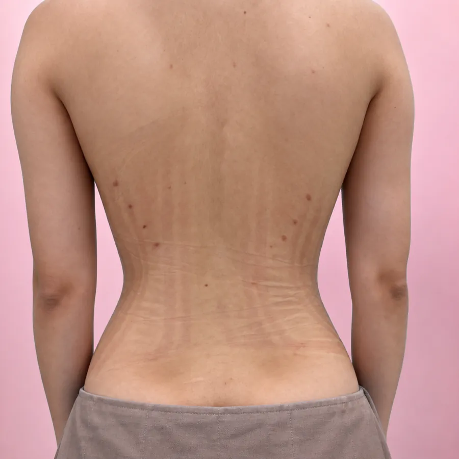 Case 01 — vùng lưng, sau thực hiện