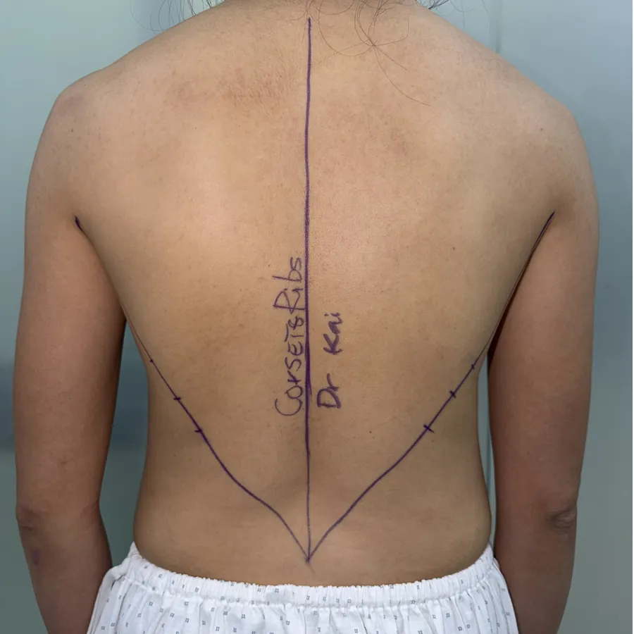 Case 01 — vùng lưng, trước thực hiện