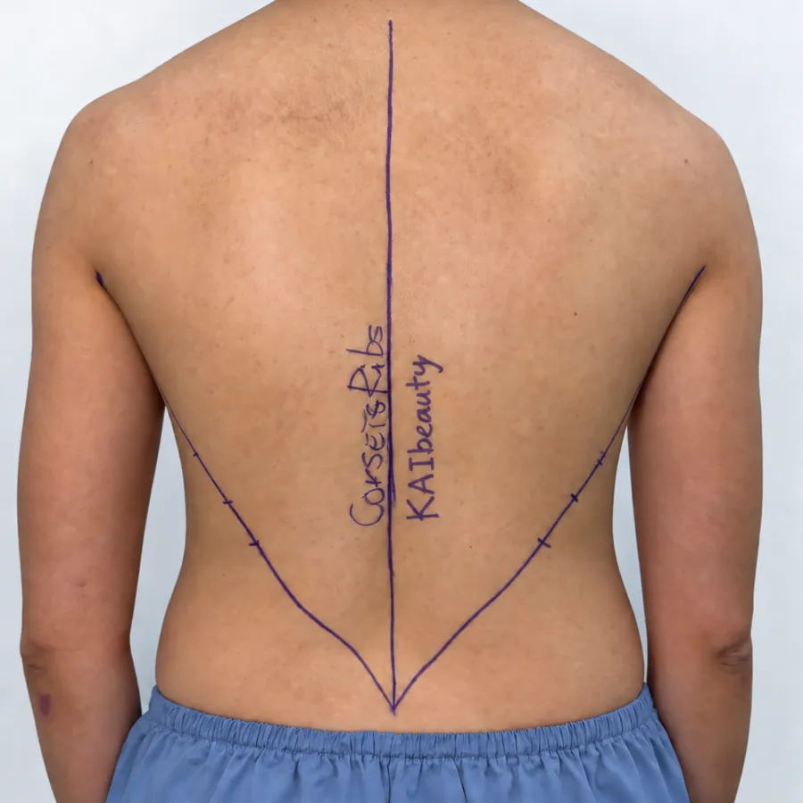 Case 04 — vùng lưng, trước thực hiện