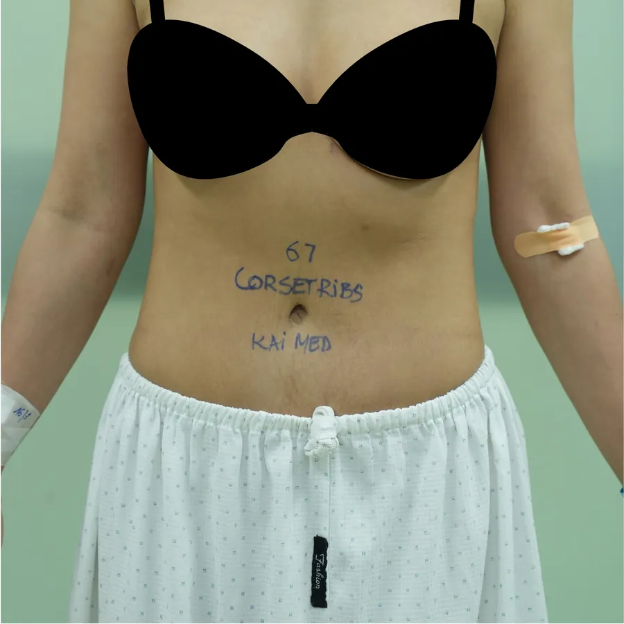 Case 05 — vùng bụng, trước thực hiện