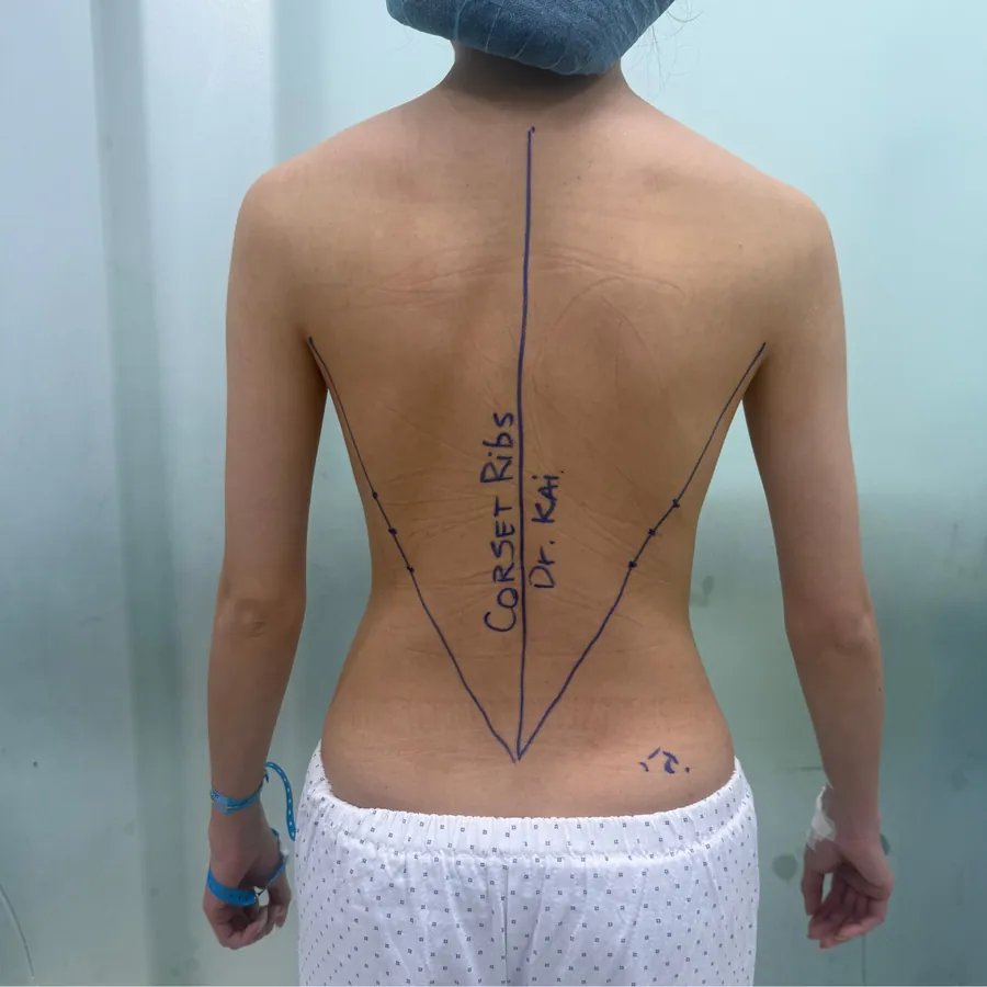 Case 07 — vùng lưng, trước thực hiện
